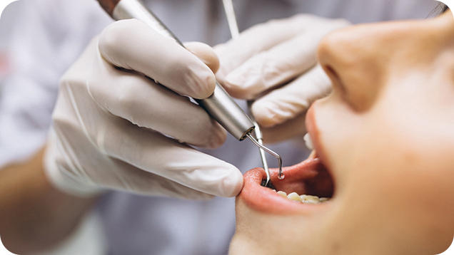 Higienização do periodonto para evitar complicações